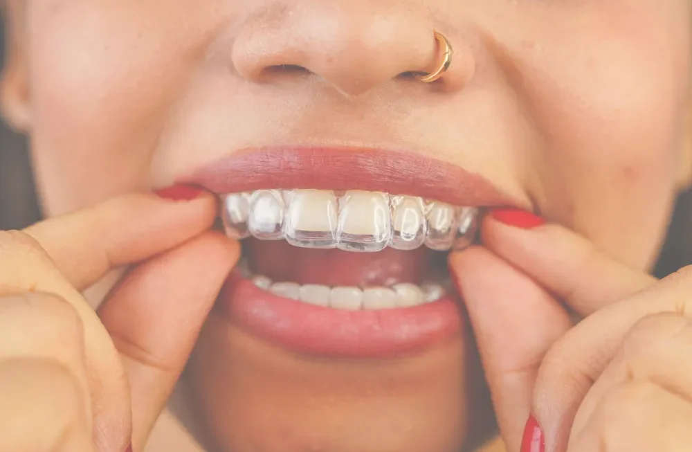 You receive your aligners in clinic with clear instructions on wear time, changing trays, cleaning them and keeping treatment on track. || If you struggle with comfort, routine or questions during treatment, further guidance can be provided so the process feels easier to manage.