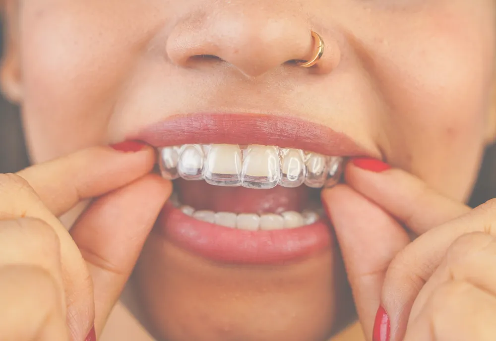 You receive your aligners in clinic with clear instructions on wear time, changing trays, cleaning them and keeping treatment on track. || If you struggle with comfort, routine or questions during treatment, further guidance can be provided so the process feels easier to manage.